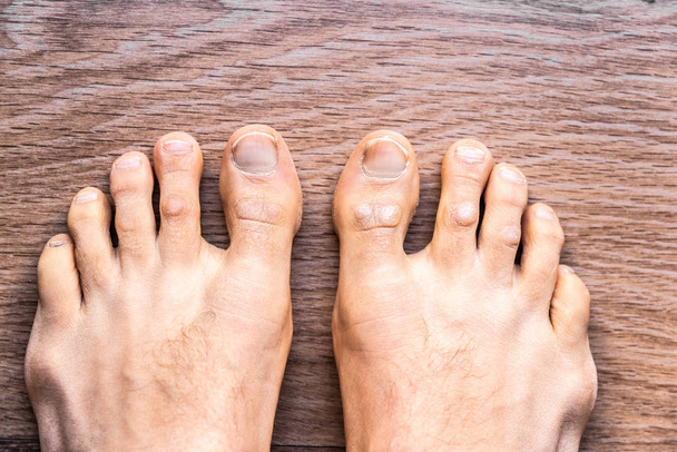 Feet of barefoot man with psoriasis dermatitis on his fingers. - Photo, Image