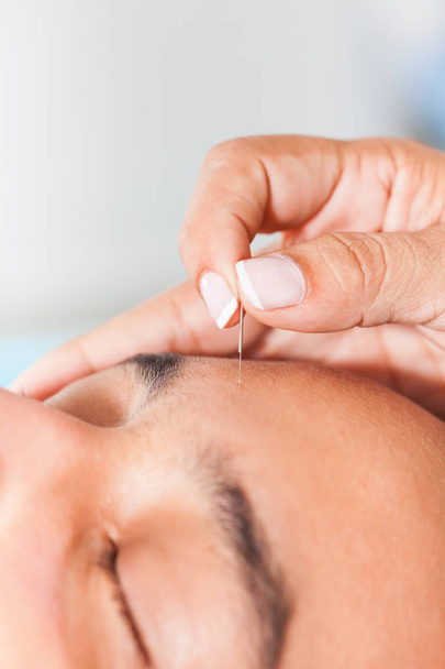 Lékaře provádějícího obličeje akupunktura na mladého muže - Fotografie, Obrázek