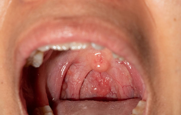 Sore throat with throat swollen. Closeup open mouth with posterior pharyngeal wall swelling and uvula and tonsil. Influenza follicles in the posterior pharyngeal wall. Upper respiratory tract. - Photo, Image