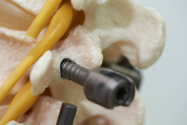 Vista ravvicinata del modello di colonna vertebrale lombare e fissazione dello strumento
 - Foto, immagini