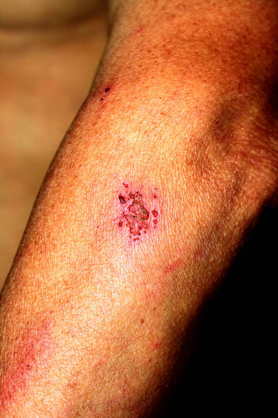 Abrasion on the arm. Wound on the elbow. - Photo, Image