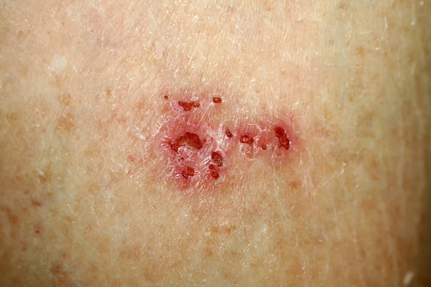 Herida en la piel. Psoriasis, dermatitis, eczema
. - Foto, imagen