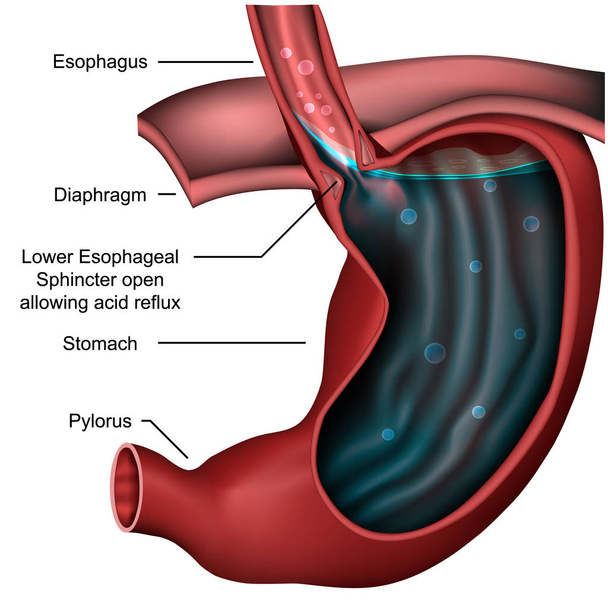 Anatómia Esophagealsphincter Reflux 3d orvosi vektoros illusztráció  - Vektor, kép