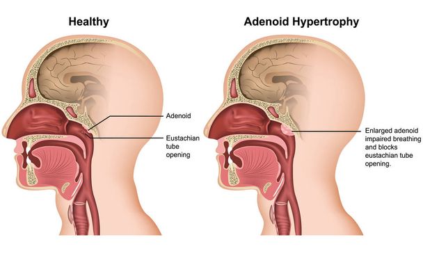 Adenoid Hypertrophie medizinische Vektor-Illustration auf weißem Hintergrund - Vektor, Bild