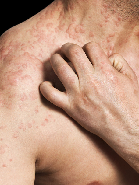 Hombre rascando la piel alérgica
 - Foto, imagen