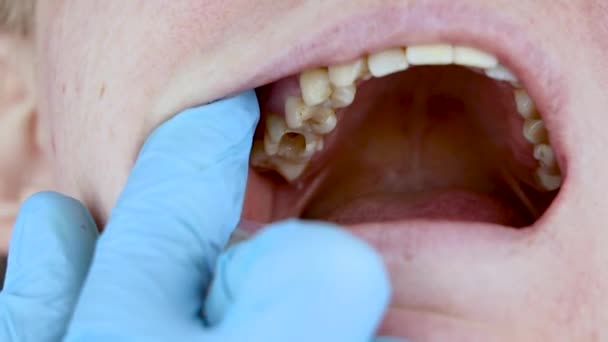 Il foro nel dente e il trattamento dei canali dentali. Trattamento della parodontite nella clinica dentale
 - Filmati, video