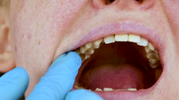 歯と歯の根管の治療穴。歯科医院で歯周炎の治療 - 映像、動画