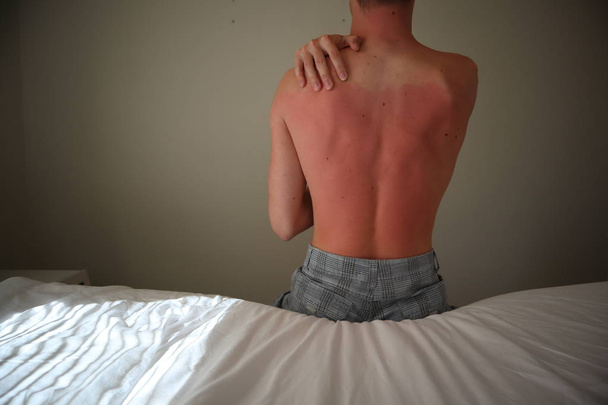 burned back. A man with reddened, itchy skin after sunburn. Skin care and protection from the sun's ultraviolet rays. Man with sunburned skin.  - Фото, изображение
