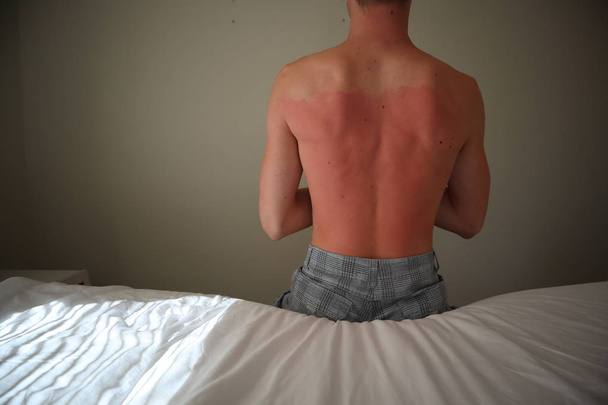 burned back. A man with reddened, itchy skin after sunburn. Skin care and protection from the sun's ultraviolet rays. Man with sunburned skin.  - Фото, изображение
