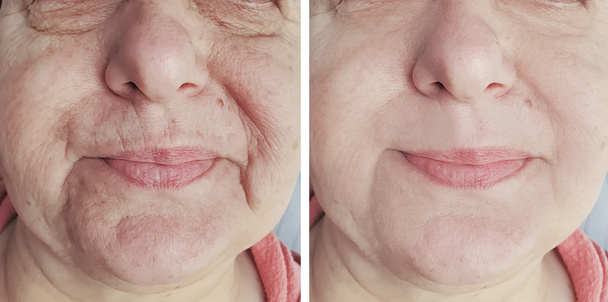 Rugas da mulher idosa antes e depois dos procedimentos
 - Foto, Imagem