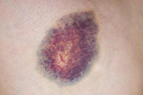 Closeup on a Bruise on wounded woman leg skin. Close up on a bruise on wounded woman leg skin. Gender violence concept - Photo, Image
