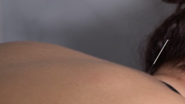 Acupuncturist spikes een acupunctuur naald op de rug van een vrouw patiënt - Video