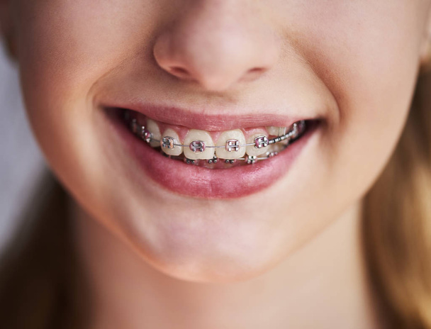 Close up of teeth with braces  - Fotó, kép
