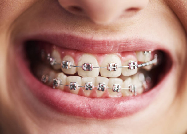Colpo di denti di bambino con bretelle
 - Foto, immagini