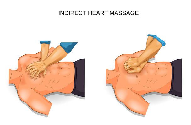 Opcje pośredni masaż serca - Wektor, obraz