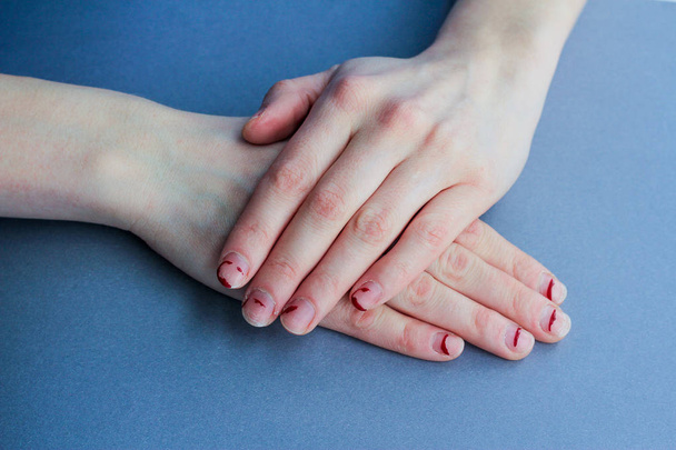 chipped, stratified nails. nails after gel Polish. untidy hands on a blue background. - Foto, immagini