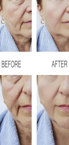 old woman wrinkles before and after treatments - Photo, Image