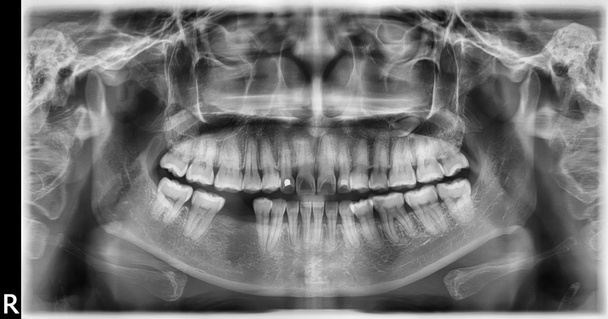 Radiographie panoramique dentaire de la mâchoire supérieure et inférieure (Orth
 - Photo, image