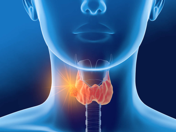 Cancer de la thyroïde chez une femme, illustration médicalement 3D, vue de face
 - Photo, image