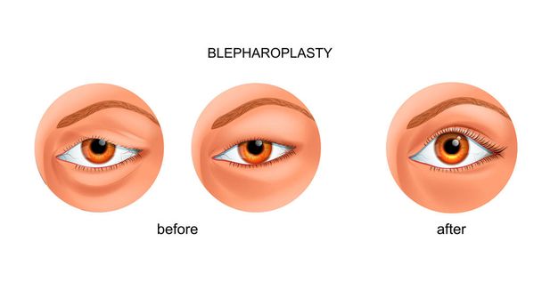 Blepharoplastik des überhängenden Augenlids und des asiatischen Augenlids - Vektor, Bild