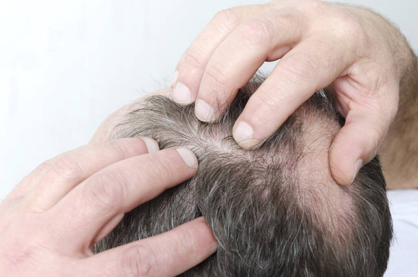 Primer plano de la cabeza calva de los hombres. hombre cheking su retroceso hairline
 - Foto, Imagen