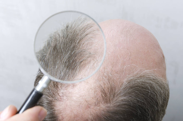 Man has a problem with hair loss.Concept of searching for solution to stop hair loss.Closeup of magnifuing glass above the bald head - Photo, Image