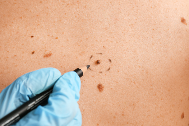 Дерматолог наносит отметины на кожу пациента перед удалением родинок, крупным планом
 - Фото, изображение