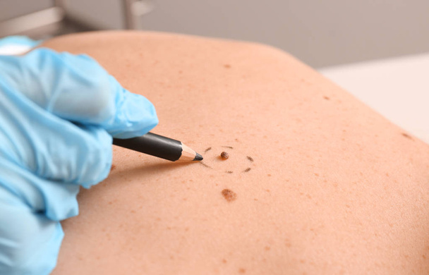 Дерматолог наносит отметины на кожу пациента перед удалением родинок, крупным планом
 - Фото, изображение