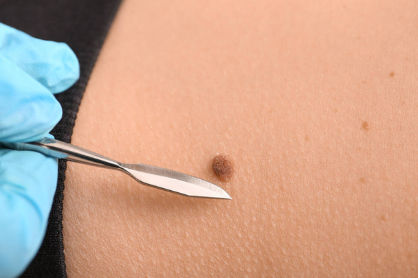 Doctor with lancet going to remove mole from patient's skin, closeup - Photo, Image
