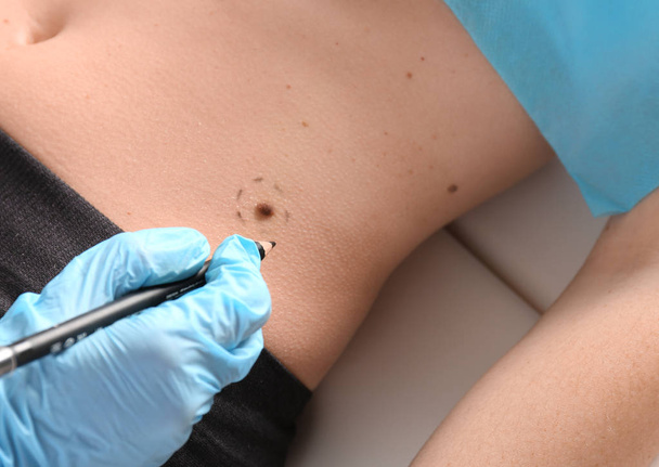 Hautarzt trägt vor der Entfernung der Muttermale Markierungen auf die Haut des Patienten auf - Foto, Bild