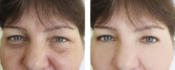 Yaşlı kadın yüz önce ve tedavi sonrası kırışıklıkları - Fotoğraf, Görsel