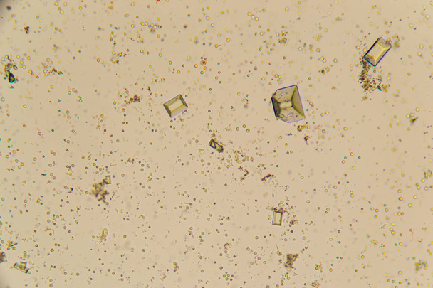 İdrar kristalleri, kırmızı kan hücreleri ve lökosit, mikroskop - Fotoğraf, Görsel