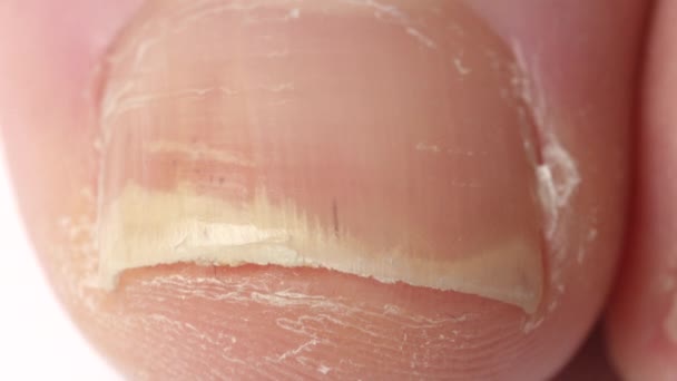 クローズアップ:爪床から分離した肥厚乾癬爪の詳細。真菌感染の影響を受ける厚い黄色の爪。爪の変形、剥離、穴あけ。乾癬症状、スケーリング - 映像、動画