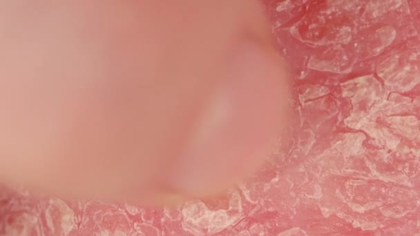 クローズアップマクロ:指先の詳細は、赤と炎症を起こした乾癬性皮膚湿疹を引っ掻きます。ドライシルバースケールと表皮組織剥離。乾癬の病気の影響を受ける損傷した異常な皮膚のパッチ - 映像、動画