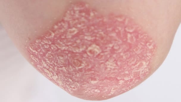 クローズアップ、マクロ:乾癬と呼ばれる自己免疫疾患の影響を受ける肘の赤い炎症を起こした皮膚を覆う乾燥した銀スケールの詳細。重篤な症状を伴う皮膚アレルギー。皮膚炎発疹と醜い湿疹 - 映像、動画