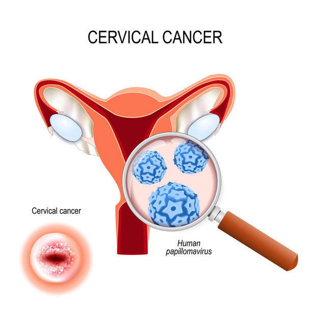 Servikal kanser. Human papilloma virüsü enfeksiyonunun yakın çekim (HPV - Vektör, Görsel