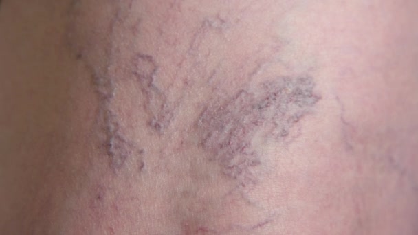 Αργή κίνηση μακρο: γαλαζοπράσινα μπλε κιρσούς στο πίσω μέρος του γόνατος μιας ανώτερης γυναίκας. Κλείστε την όψη των προβληματικών φλεβών της κυρίας στο γραφείο του γιατρού πριν από τη θεραπεία. Εξέταση των αιμοφόρων αγγείων των ποδιών. - Πλάνα, βίντεο
