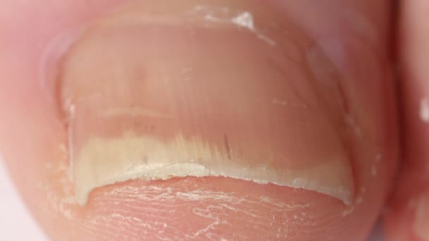 クローズアップ, マクロ: 欠陥のあるつま先の爪に抗真菌またはコルチコステロイド溶液を適用する認識できない人.爪を分離し、爪を取り除く厚みのための治療。乾癬性関節炎 - 映像、動画
