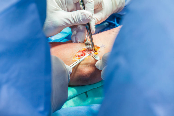 Groep orthopedische chirurgen die een operatie uitvoeren op een patiënt arm - Foto, afbeelding
