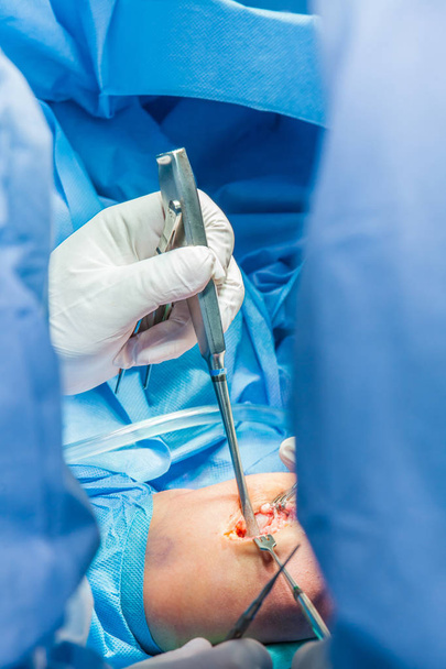 Grupa chirurgów ortopedycznych wykonujących operację na ramieniu pacjenta - Zdjęcie, obraz
