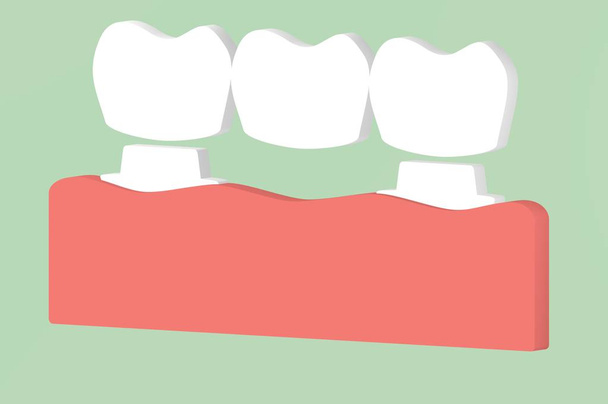 Korona dentystyczna z mostkiem, proces instalacji i zmiana zębów - Zdjęcie, obraz