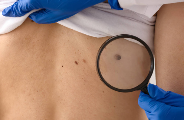 Dermatologist examining moles of patient, closeup - Photo, Image