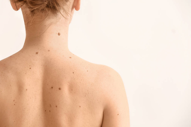 Young woman with moles on white background - Fotografie, Obrázek