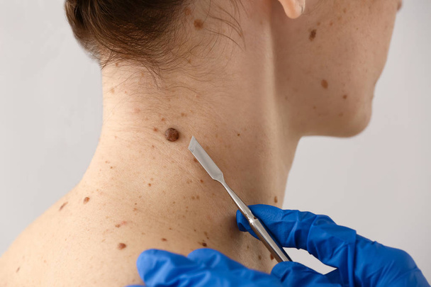 Doctor with lancet going to remove mole from patient's skin, closeup - Фото, зображення