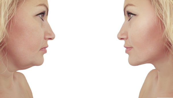プロシージャの前と後の女性の二重あごのたるみ - 写真・画像