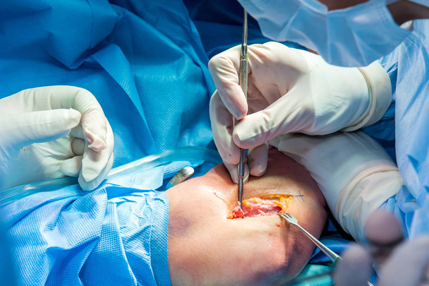 Grupo de cirujanos ortopédicos que realizan cirugía en un brazo de paciente
 - Foto, Imagen
