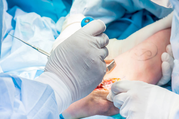 Hasta kolunda ameliyat yapan Ortopedi Cerrahları grubu - Fotoğraf, Görsel