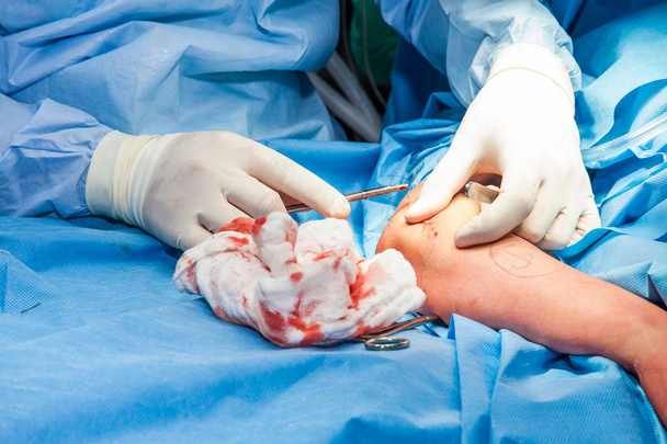 Chirurg, der den Arm eines Patienten am Ende der Operation vernäht - Foto, Bild