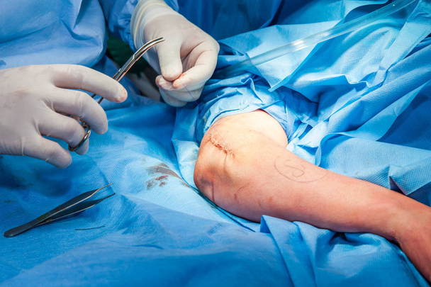Chirurg hechten de arm van een patiënt aan het einde van de operatie - Foto, afbeelding