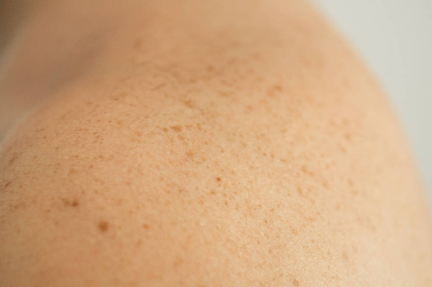 Nahaufnahme der nackten Haut auf dem Rücken eines Mannes mit verstreuten Muttermalen und Sommersprossen. Kontrolle gutartiger Maulwürfe - Foto, Bild
